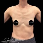 Breast Augmentation Before & After Patient #1021