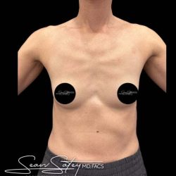 Breast Augmentation Before & After Patient #1021