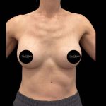 Breast Augmentation Before & After Patient #1021
