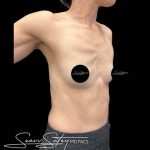 Breast Augmentation Before & After Patient #1021