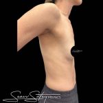 Breast Augmentation Before & After Patient #1021
