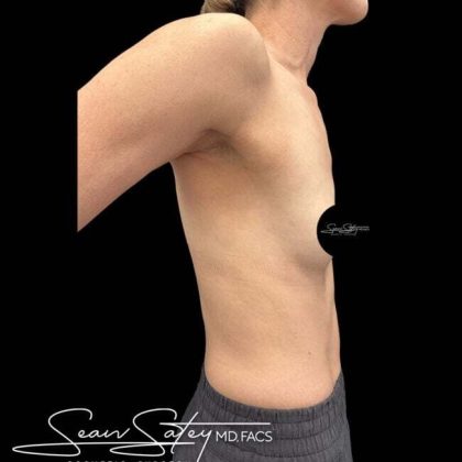 Breast Augmentation Before & After Patient #1021