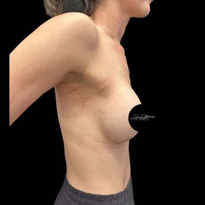 Breast Augmentation Before & After Patient #1021