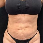 Tummy Tuck Before & After Patient #1022
