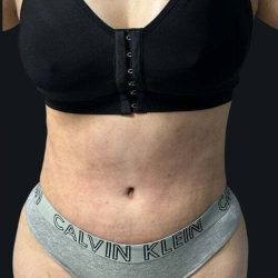 Tummy Tuck Before & After Patient #1022