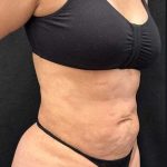 Tummy Tuck Before & After Patient #1022