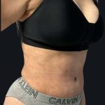 Tummy Tuck Before & After Patient #1022