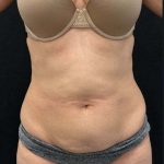 Tummy Tuck Before & After Patient #1023