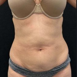 Tummy Tuck Before & After Patient #1023