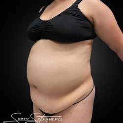 Tummy Tuck Before & After Patient #1014