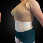 Tummy Tuck Before & After Patient #1014