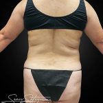 Tummy Tuck Before & After Patient #1014