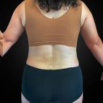 Tummy Tuck Before & After Patient #1014