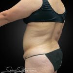 Tummy Tuck Before & After Patient #1014