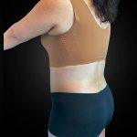 Tummy Tuck Before & After Patient #1014