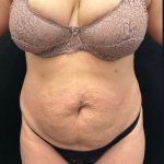 Brazilian Butt Lift Before & After Patient #2362