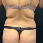 Brazilian Butt Lift Before & After Patient #2362