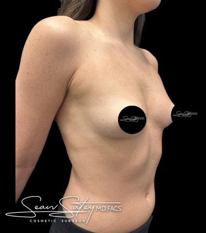 Breast Augmentation Before & After Patient #2374