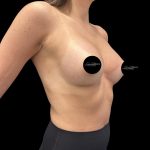 Breast Augmentation Before & After Patient #2374