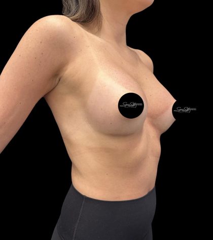 Breast Augmentation Before & After Patient #2374