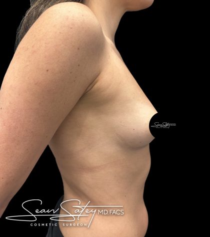 Breast Augmentation Before & After Patient #2374