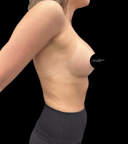 Breast Augmentation Before & After Patient #2374
