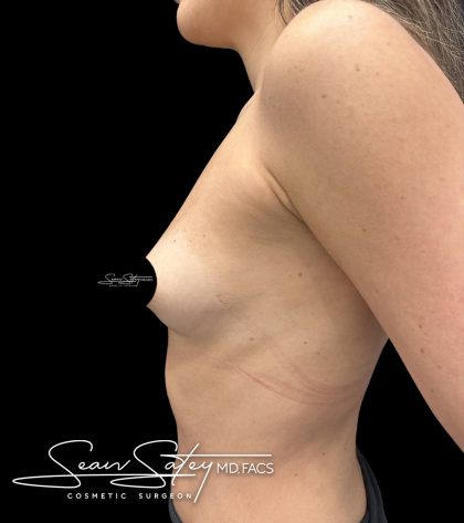 Breast Augmentation Before & After Patient #2374