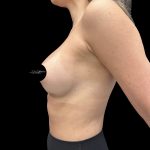 Breast Augmentation Before & After Patient #2374