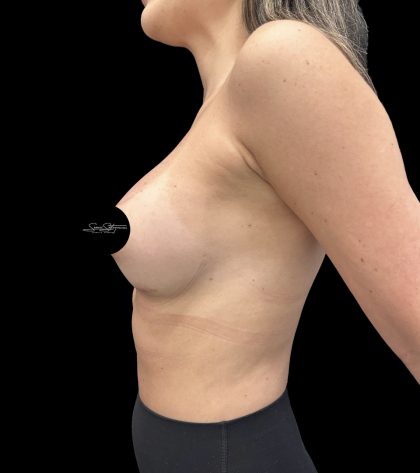 Breast Augmentation Before & After Patient #2374