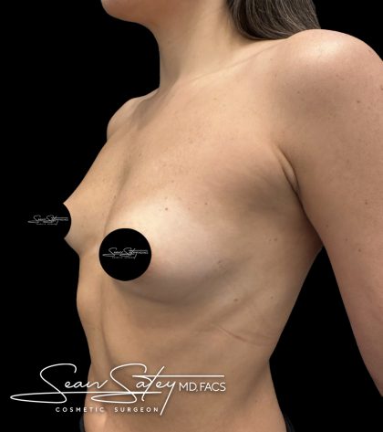 Breast Augmentation Before & After Patient #2374