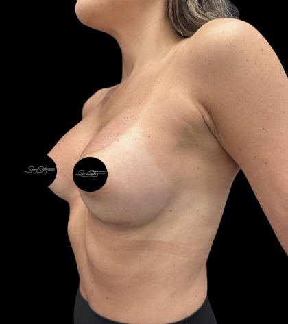 Breast Augmentation Before & After Patient #2374