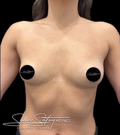 Breast Augmentation Before & After Patient #2374