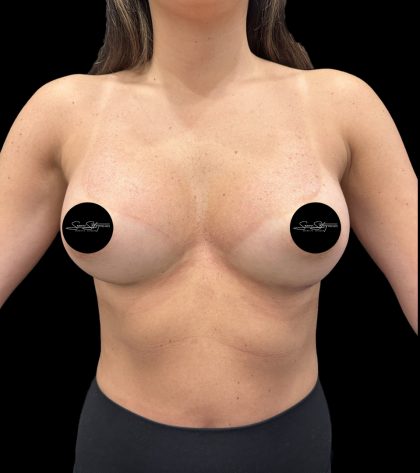 Breast Augmentation Before & After Patient #2374