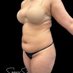 Brazilian Butt Lift Before & After Patient #2383