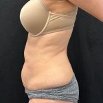 Brazilian Butt Lift Before & After Patient #2402