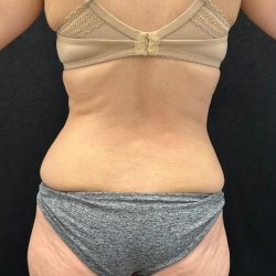 Brazilian Butt Lift Before & After Patient #2402