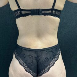 Brazilian Butt Lift Before & After Patient #2402