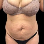 VASER Liposuction Before & After Patient #2362