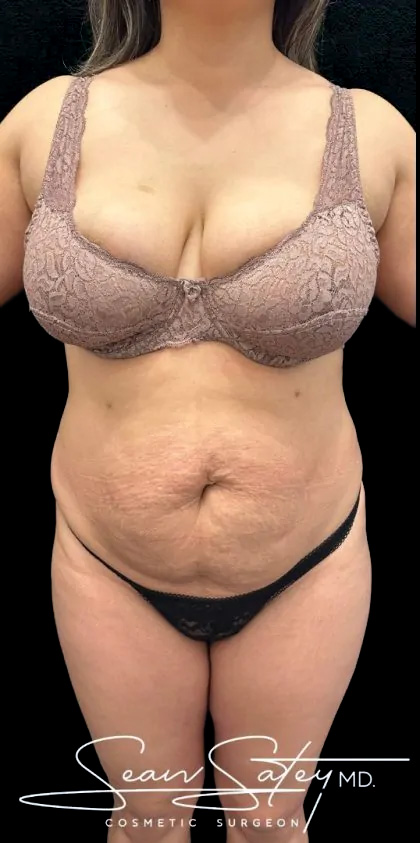 VASER Liposuction Before & After Patient #2362