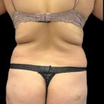 VASER Liposuction Before & After Patient #2362
