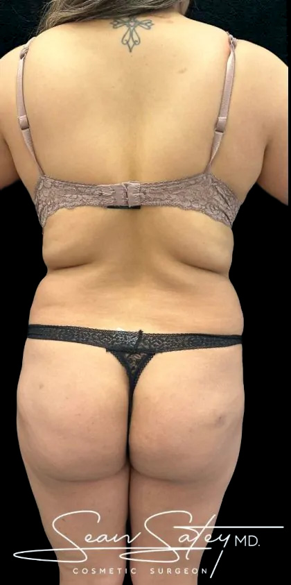VASER Liposuction Before & After Patient #2362