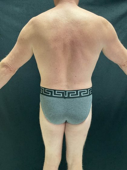 VASER Liposuction Before & After Patient #2521