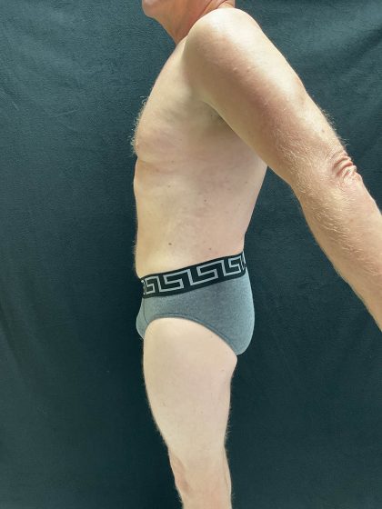 VASER Liposuction Before & After Patient #2521