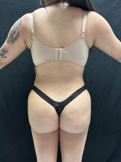 VASER Liposuction Before & After Patient #2614