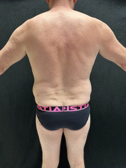 VASER Liposuction Before & After Patient #2521