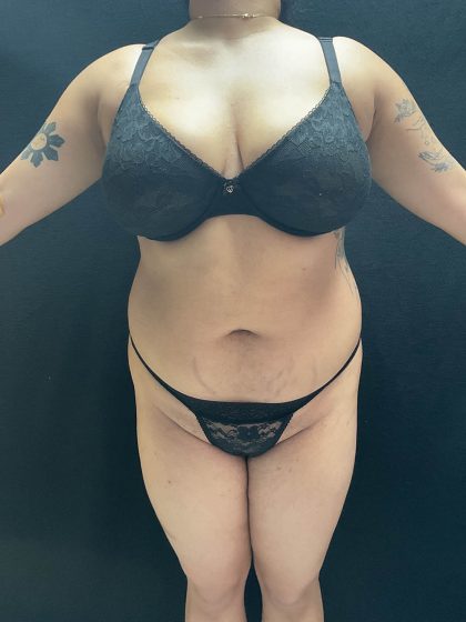 VASER Liposuction Before & After Patient #2614
