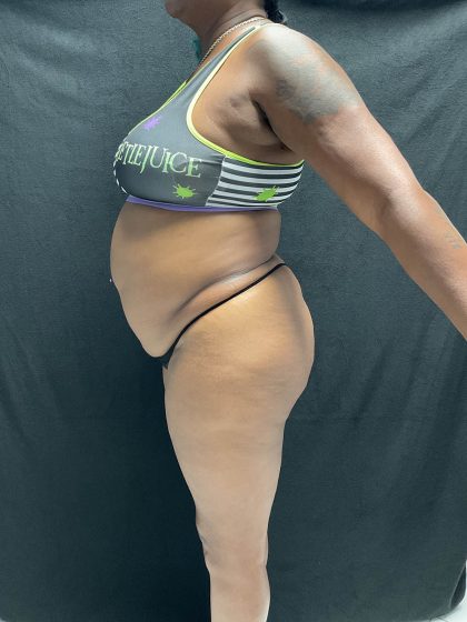 VASER Liposuction Before & After Patient #2609