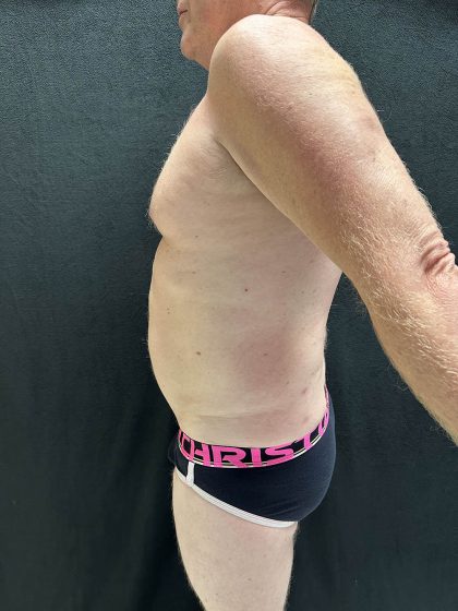 VASER Liposuction Before & After Patient #2521