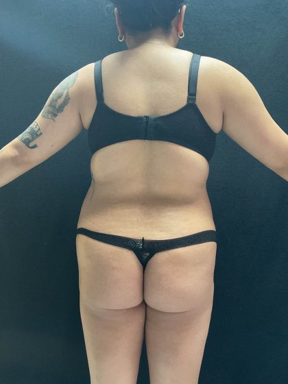 VASER Liposuction Before & After Patient #2614