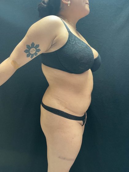 VASER Liposuction Before & After Patient #2614